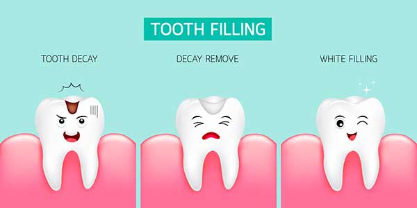 Tooth-Filling Tooth-Filling