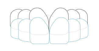 custom-tooth-tray-cen